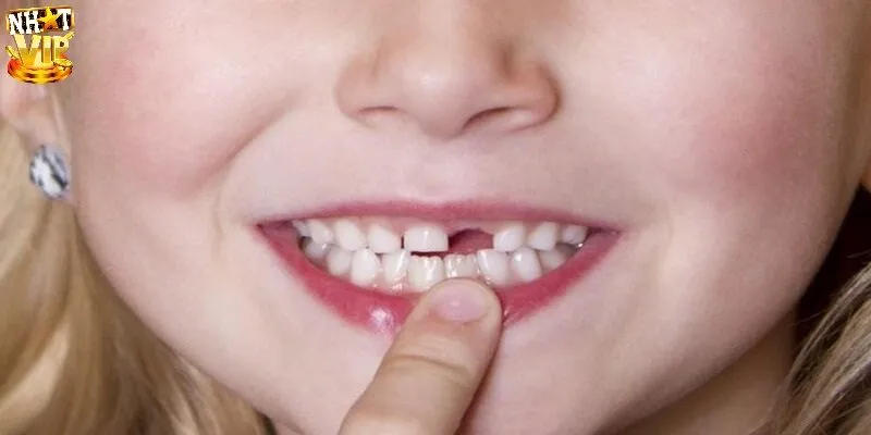 Mơ Thấy Răng Rụng - Giải Mã Điềm Báo Và Con Số May Mắn Mơ thấy răng rụng do bị tai nạn